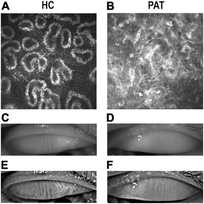 The Predictive Potential of Altered Voxel-Based Morphometry in Severely Obese Patients With Meibomian Gland Dysfunction
